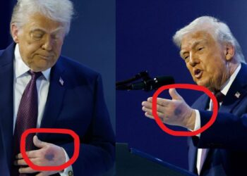 Trump Hand Mark: क्या बीमार हैं डोनाल्ड ट्रंप? दावोस की मीटिंग में हाथ पर दिखा गहरा जख्म, खुद बताई इसकी वजह? | donald trump hand blue mark davos wef aspirin overdose health controversy explained hindi
