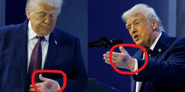 Trump Hand Mark: क्या बीमार हैं डोनाल्ड ट्रंप? दावोस की मीटिंग में हाथ पर दिखा गहरा जख्म, खुद बताई इसकी वजह? | donald trump hand blue mark davos wef aspirin overdose health controversy explained hindi
